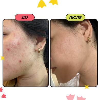 Пристрій для електричного неінвазивного мікронідлінгу та звуження пор Medicube AGE-R ATS Air Shot Купити оптом в Україні